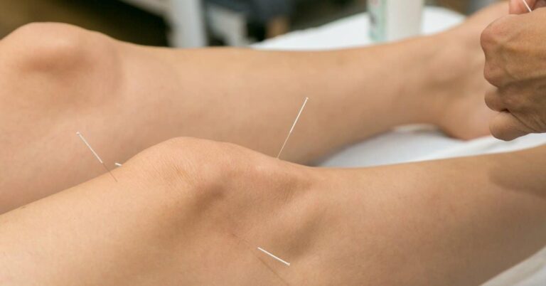 Mehr über den Artikel erfahren Was bringt Akupunktur bei Knieschmerzen?
