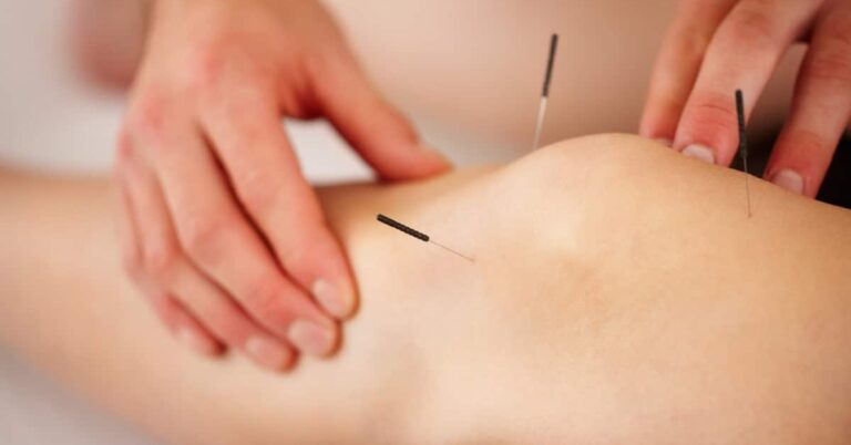 Mehr über den Artikel erfahren Anwendungsmöglichkeiten der Akupunktur: Was Sie wissen sollten
